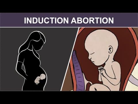Thumbnail for 3rd Trimester Induction Abortion: Injection and Stillbirth